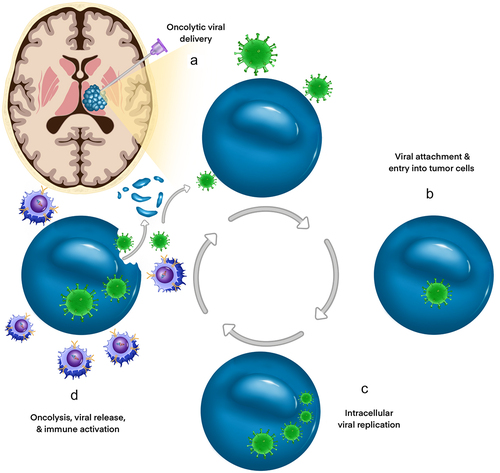 Figure 3. Mechanisms of DMG targeting by immunovirotherapy. Oncolytic viruses (OV) are promising novel therapies for DMG as they can be delivered directly via intratumoral injection (a), bypassing the BBB. OV entry (b) and replication (c) within DMG cells induces direct oncolysis and release of new viral particles into the tumor bed, facilitating further inoculation and lysis of surrounding tumor cells (d). Tumor cell debris increases the exposure of the patient’s immune system to both existing and novel tumor antigens, bolstering immune-mediated anti-tumoral effects.