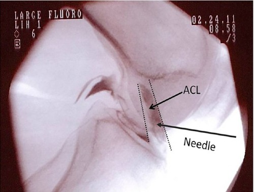 Figure 1 ACL injection with fluoroscopy.