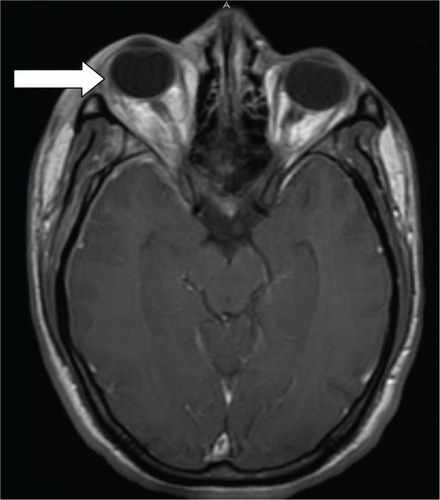 Figure 2 Right eye proptosis (arrow).