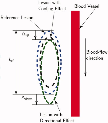 Figure 5. Schematic of the cooling effect (black outline) and the directional effect (green line) of a blood vessel on a thermal lesion. The cooling effect reduces the lesion size, while the directional effect causes stretching in the flow direction. Definition of Δup,Δdown, and lref used to define the ΔA directional effect metric shown. The cross-section is the one containing the vessel axis and the shortest line segment connecting the vessel axis and the RF-needle axis.
