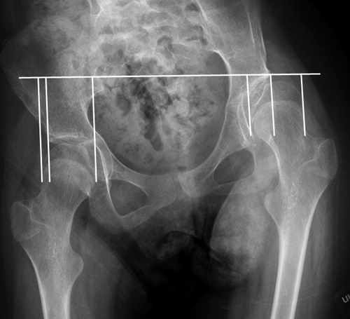 Figure 1c. Measurement of pelvic adjusted migration percentage (PAMP). PAMP =59% in the left hip and 15% in the right hip.