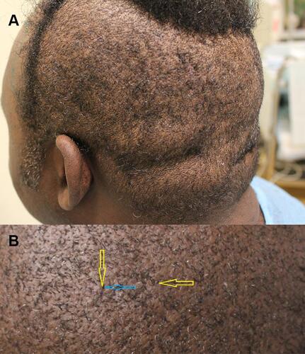 Figure 2 Example of thick/firm scalp. Patient 2 male patients of African descent. Left posterior oblique view showing thick firm scalp (A). Closer up view of thick firm scalp, showing peau d’Orange surface, hairs exiting from craters (pits) with hoods (yellow arrows), and bunched/bouquet hair (blue arrow). Chaotic hair directions (asynchrony) are evident (B).