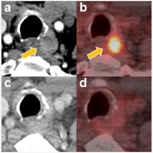 Figure 2. A 63-year-old man with recurrent thyroid cancer.(a) contrast-enhanced CT before RFA and RT, showing one enhanced mass invading the tracheal wall and esophageal wall; (b) PET-CT before RFA and RT, showing increased FDG uptake in the paratracheal mass lesion (SUV max: 22.25); (c) contrast-enhanced CT 39 months after RFA and RT, showing that the recurrent tumor had almost completely disappeared; (d) PET-CT 6 months after RFA and RT, showing background FDG avidity with complete metabolic response in the left paratracheal region; CT, computed tomography; RFA, radiofrequency ablation; RT, radiotherapy; PET-CT, positron emission tomography and computed tomography; FDG: fludeoxyglucose F-18; SUV max, maximum standardized uptake value