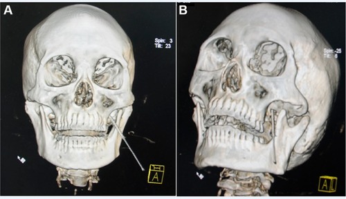 Figure 2 A 3D CT reconstruction showing the trajectory of the needle after insertion.