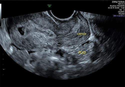 Figure 4. Pouch of Douglas: no free fluid seen.