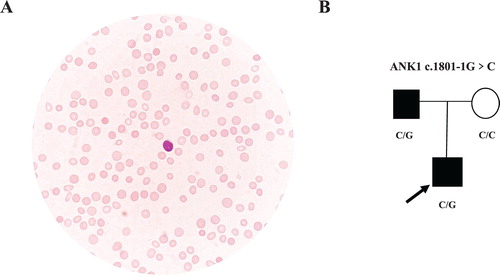 Figure 1. Heterozygous ANK1 c.1801-1G > C mutation in two patients from a Chinese family with hereditary spherocytosis. A. Spherocytes were observed in the film of the proband. B. Family tree and the genotype at the ANK1 c.1801-1 position. Squares and circles denote males and females, respectively. Black symbols denote patients with HS.