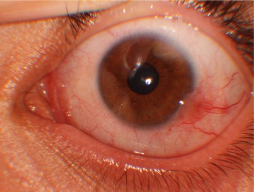 Figure 3 Clinical photograph of a nodular lesion in the bulbar conjunctiva.