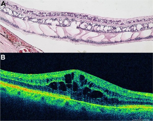 Figure 49 (A) Histological cross section of CME. (B) SD-OCT cross section of pseudophakic CME with retinal thickening, cystic intraretinal, and subretinal fluid.