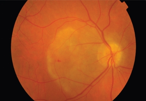 Figure 1 Fundus appearance of the right eye at initial presentation. There was a larger yellowish placoid lesion, with a small splinter haemorrhage in the macular region and mild vitreous inflammation.
