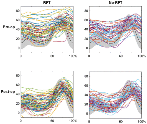 Figure 2 Mean Knee flexion extension angles (in degrees) of all the patients contituting the subgroup RFT and No-RFT after the Propensity Score Matching, before and after surgery. Data are normalized by gait cycle duration. The shaded area represent normative data.