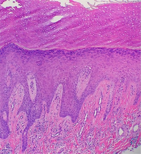 Figure 2 A section showing orthohyperkeratosis, hypergranulosis, elongation of the rete ridges, vertical arrangement of collagen fibers, and increased number of capillaries.