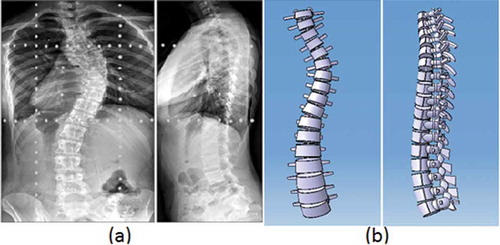 Figure 4. Subject-1 (a) Biplanar x-rays (b) Feature-based model.