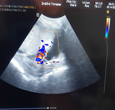 Figure 1 Ultrasonography revealed multiple lacunae, loss of serosal-bladder interface, placenta previa. Based on these, we suspected a placenta accreta spectrum.