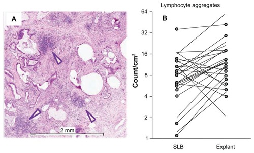 Figure 3 Lung explant histology (A) from a typical patient demonstrating selected aggregates of mononuclear cells ≥ 100 μm in diameter (arrowheads) which were counted as lymphocyte aggregates. A scatter plot (B) composed of numerical counts of lymphocyte aggregates compares upper lobe SLB to upper lobe explant (unmarked ends) and lower lobe SLB to lower lobe explant (circled ends) for each individual patient.Note: There were more lymphocyte aggregates in the explant samples compared to SLB across the cohort (P = 0.013, Wilcoxon signed rank test).Abbreviation: SLB, surgical lung biopsy.