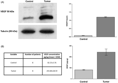 Figure 2. Evaluation of VEGF in ccRCC samples. Protein levels evaluated by WB (panel A) or ELISA (panel B) of VEGF in normal tissue (Control) and tumour sample (tumour). In panel A, right side, are reported the densitometric values of samples of WB from eight patients (differences were significant for p ≤ .005 with t-test). In panel A, left side, WB of VEGF from a representative patient is reported. Tubulin housekeeping protein was used to normalise values in WB. VEGF concentration by ELISA from same patients (panel B, left and right side) is expressed as pg/µg. Differences were significant for p ≤ .005 with t-test.