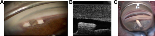 Figure 3 Scleral allograft used for intraocular reinforcement. (A) Gonioscopic image of two allograft spacers used for cyclodialysis bio-scaffolding and reinforcement. (B) OCT image of an allograft intraocular spacer (C) Scleral allograft bio-scaffolding spacer during ab-interno surgical deployment.