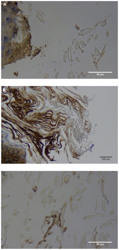 Figure 2 (A) Filament cross, oblique, and lateral sections, from a specimen collected from patient 1 showing round, elliptical/elongated, bean-like, or curved morphology. Note the hollow medulla and surrounding cortex. Cytokeratin (CK) AE1/AE3 staining. 100× magnification. (B) Specimen from patient 1, demonstrating irregular, patchy keratin staining with CK AE1/AE3, longitudinal section. Note most filaments staining positive for keratin (dark brown). 100× magnification. (C) Specimen from patient 1, demonstrating irregular, patchy keratin staining with CK AE1/AE3. Cross, oblique, and longitudinal sections. Note most filaments staining negatively for keratin. 400× magnification. (D) Longitudinal section of filament from patient 1. Note retained nuclei, central medulla, and patchy keratin staining with CK AE1/AE3. 400× magnification. (E) Sectioned filament from a specimen from patient 1, which upon gross microscopic examination demonstrated floral-like or stellate formations. Note retained nuclei within tentacle-like filaments with tapered ends. CK AE1/AE3 staining. 400× magnification. (F) Sectioned callus from patient 1, showing filaments stemming from the stratum basale with evolution inwards towards the dermis. Note filament sections with hollow medulla alongside the stratum basale. CK AE1/AE3 staining. 100× magnification. (G) Gömöri trichrome collagen-positive section of activated fibroblasts with filamentous inclusions from patient 2. Collagen stains green, keratin stains red. Growth of filaments was upwards toward the external surface. 400× magnification. (H) Ruptured keratin projection from both external and internal surfaces from a specimen collected from patient 2, with areas of fibroblast proliferation stained green. Gömöri trichrome stain. 100× magnification. (I) Section from patient 2 stained with Gömöri trichrome, demonstrating both keratin (red) and collagen (green) filament cross-sections, with most filaments associated with the external callus surface. 100× magnification. (J) Gömöri trichrome stain of specimen from patient 2, demonstrating filaments in longitudinal, oblique, and cross-sections close to and within collagen-positive fibroblast collections (green). Note presence of filament cross-sections staining positively for keratin (red). 400× magnification. (K) Bovine digital dermatitis (BDD) filament, longitudinal section, showing positive CK AE1/AE3 staining. 100× magnification. (L) BDD filament, longitudinal section, showing negative CK AE5/AE6 staining. 100× magnification.