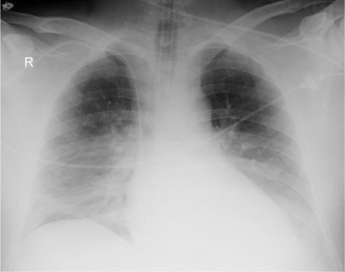 Figure 1 X-ray of chest of first case – ARDS following massive gastric content aspiration.