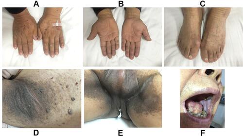 Figure 6 After three courses of chemotherapy, hyperkeratosis of the hands and feet (A–C), pigmentation and verrucous hyperplasia on the axillary (D) and inguinal (E) regions and lesions in the oral cavity (F) were all significantly improved.