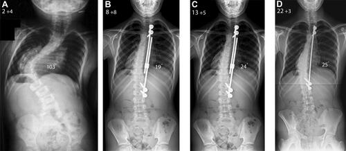 Figure 1 Male patient aged 2 years and 4 months with a very severe infantile idiopathic thoracic scoliosis (patient 1; (A). The patient was treated with TGRs which were inserted at age 2.5 years. Repeat lengthenings were performed every 6 months and controlled the coronal deformity until the age of 13.5 years (B, C) when the patient underwent the definitive posterior spinal fusion. The distal rod of the construct had to be exchanged twice due to breakage and this was performed during planned lengthening procedures. At final follow-up aged 22 years and 3 months, the patient had a balanced spine with good correction of the scoliotic deformity (D).