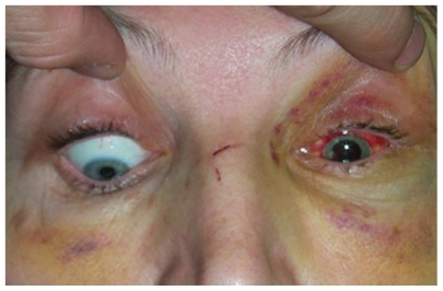 Figure 3 A patient with a left orbital floor fracture and inferior rectus entrapment demonstrates restriction of downgaze of the left eye.