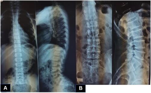 Figure 3 X-rays showing deterioration of dorsal spine ((A) 4 years old (B) 11 years old).