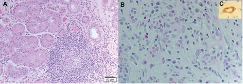 Figure 1 (A) Histopathology of Lacrimal Gland showing perivascular granulomatous inflammation with eosinophilic infiltration in Eosinophilic granulomatosis with polyangiitis (Haematoxylin-Eosin stain (H&E), magnification X 200) (B) Angiolymphoid Hyperplasia with Eosinophilia showing endothelial proliferation with scattered eosinophils H&E, magnification X 200 (C) Cluster of Differentiation. CD34 stain showing endothelial proliferation with plumped endothelial cells of the same patient.