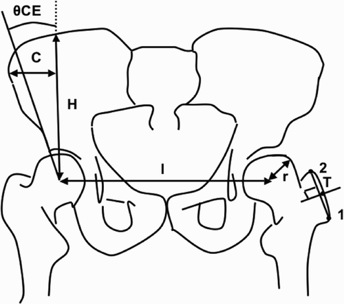 Figure 2. Pelvic radiographic parameters: interhip distance (l), pelvic width (C), pelvic height (H), radius of the femoral head (r), center‐edge angle of Wiberg (θCE), and the frontal coordinates of point T (the midpoint of the straight line connecting the most lateral point (point 1) with the highest point (point 2) on the greater trochanter) were used as input data for computation of the resultant hip force R.