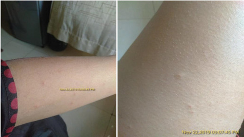 Figure 1 Rash and minimal lesions with itching. (Photo taken by patient herself.)