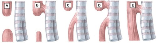 Figure 1 Anatomical classification of esophageal atresia according to Gross.