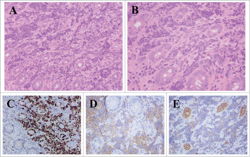 Figure 3. Pathological results from SCC of appendix. A. Hematoxylin-eosin stain (× 100). B. Hematoxylin-eosin stain (× 200). C.D.E. Immunohistochemical staining in SCC of appendix. Ki-67: 80% (× 100), Syn (+) (× 200), panCK (+) (× 200).