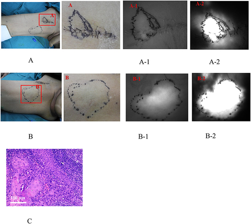 Figure 5 Preoperative ICG fluorescence imaging of the sentinel lymph nodes on the right lower limb. (A) The surface location of the groin lymph nodes; A-1. Visible light image of the groin lymph nodes; A-2. Fluorescence image of the groin lymph nodes; (B) The surface location of the lymph nodes on the inner right thigh. B-1. Visible light image of the lymph nodes on the inner right thigh; B-2. Fluorescence image of the lymph nodes on the inner right thigh; (C) The HE staining of the resected tumor tissues. The scale bar indicates 100 μm.