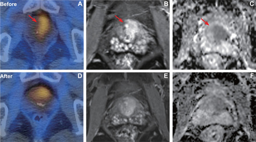 Figure 5 A patient with pathology confirmed prostate cancer of Gleason score 5+4 (T3aN0M0, very high risk) who showed poor response after CIRT. PSMA uptake (A) was visualized on the prostate with TBR of 4.87. After CIRT, the PSMA (D) uptake was still visualized on the prostate (TBR, 3.4). Axial T1 weighted MRI showed the tumor before (B) and after (E) CIRT. In baseline ADC map (C), ADCmean was 0.787× 10–3 mm2/s. In post CIRT ADC map (F), ADCmean was 0.812 × 10–3 mm2/s.