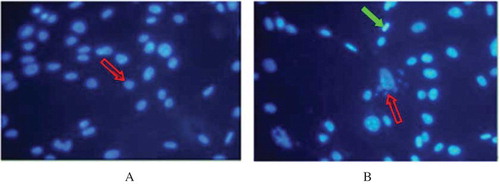 FIGURE 3. Epifluorescent micrographs showing Hoechst staining of DNA in HK-2 cells.Note: Figure A stands for the HK-2 cells of normal control group; Figure B stands for the HK-2 cell of MG group, which were treated with 0.5mMol/L MG for 24 h. In figure A, shows normal nucleolus. Exposure to MG resulting in karyopyknosis and deepened stain () and the appearance of apoptotic bodies ( in figure B). Photographs taken at a magnification of × 400 (n = 4).