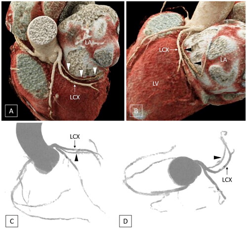 Figure 2. Volume rendered images (A and B) and virtual angiography images (C and D) reveal the anomalous course of the left atrial circumflex artery (arrowheads) arising from the left circumflex (LCx) artery mimicking a ‘dual’ left circumflex artery. LA: left atrium; LV: left ventricle (From reference [Citation25]).