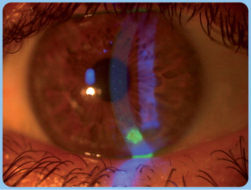 Figure 2. Moderate dry eye with punctuate corneal fluorescein staining and excessive mucus formation on the corneal surface.