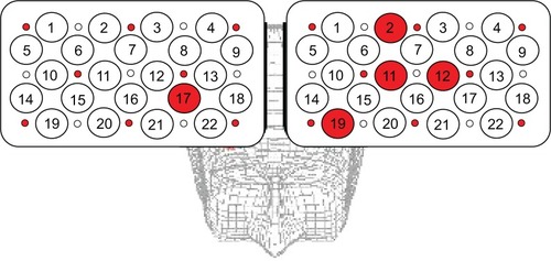 Figure 2 Maps of cortical distribution of channels that were significantly smaller in patients than in healthy subjects.