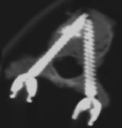 Figure 2. TDM view with a right cemented screw and a left large diameter pedicle screw.