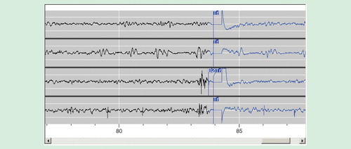 Figure 3. Example of a four-channel ECoG segment stored by the neurostimulator as displayed on the PDMS. In this example, the neurostimulator has been programmed to detect paroxysmal high-amplitude sharply contoured discharges on channel 3, which is typical of this patient’s interictal epileptiform activity. ‘B2’ denotes detection of epileptiform activity on the third channel. ‘Tr’ indicates delivery of responsive stimulation. Following the initial detection, the electrocoticogram is displayed in blue. When responsive stimulation is delivered, and immediately afterward, there is an artifact in the recording.