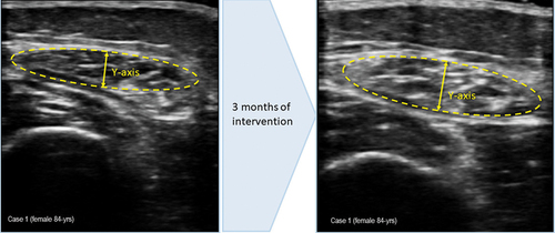 Figure 1. (a) measurement of muscle ultrasound images upon arrival at the endocrinology and nutrition unit. Muscle thickness (Y-axis): 0.73 cm; muscle is in cm2: 2.11 cm2, (b) measurement of muscle ultrasound images at 3 months of intervention, during outpatient follow-up. Muscle thickness (Y-axis): 0.74 cm; muscle is in cm2: 2.11 cm2.