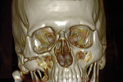 Figure 1. Pre-operative 3D CT scan showing a right Le Fort III fracture in combination with a severely comminuted orbito-zygomatic fracture and a left non-comminuted and slightly displaced orbito-zygomatic fracture.