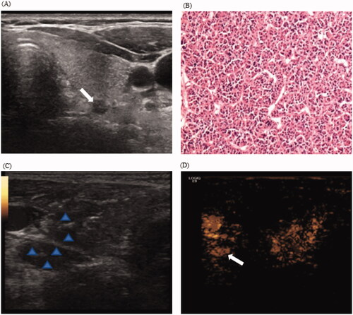 Figure 4. CEUS displaying hidden nodule during hydrodissection in a 55-year-old woman with pHPT. (A) Routine US display a hypoechoic pHPT nodule with maximum diameter of 0.5 cm; (B) Preoperative nodule FNA biopsy indicates a parathyroid adenoma with the formation of microfollicles (H&E stain, ×200). (C) During hydrodissection, nodular changes in the surrounding tissues and the pHPT nodule are hypoechoic (arrow). (D) The injection of contrast agents display the uniform enhanced parathyroid nodule (arrows). CEUS: contrasted-enhanced ultrasound; pHPT: primary hyperparathyroidism; FNA: fine-needle aspiration.