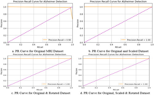 Figure 13. Precision Sensitivity (PR) Curve obtained using volumetric Convolutional neural network with different dataset approaches for Alzheimer’s Detection.