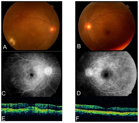 Figure 1 Fundus photograph of the right A) and the left eyes B). The right fundus shows whitish exudates, massive subretinal infiltration under the macular lesion, and slight disc swelling. The left fundus is normal. Fluorescein angiography of the right C) and left eyes D) Slight leakage of fluorescein can be seen on the right optic disc. The left eye is normal. Optical coherence tomography of the macular area of the right E) and left eye F). Massive subretinal infiltration is present in the right eye. The left eye is normal.