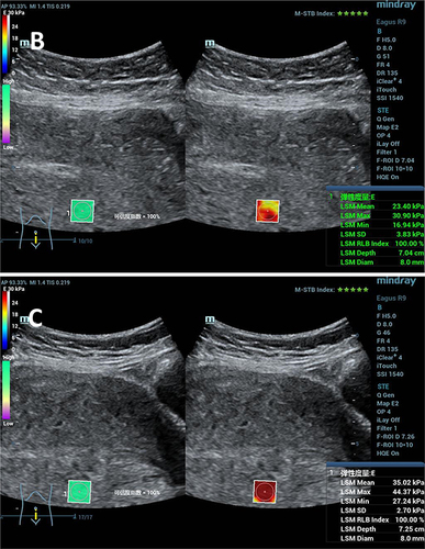 Figure 2 SWE images of postpartum posterior uterine walls.