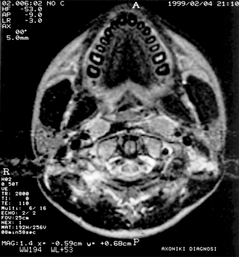 Figure 1 Central slice of magnetic resonance imaging of the mandibular teeth.