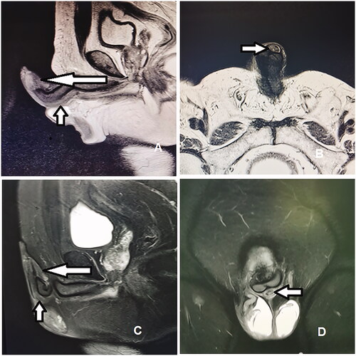 Figure 3. (A) Sagittal MRI scan of penis and urethra. (B) Transverse MRI of penis and urethra. (C) Sagittal MRI scan of penis and urethra after treatment. (D) Transverse MRI of penis and urethra after treatment.