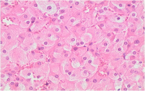 Figure 1: Haematoxylin and eosin stain demonstrating clusters of polygonal cells with granular eosinophilic cytoplasm with central nuclei (40x magnification).
