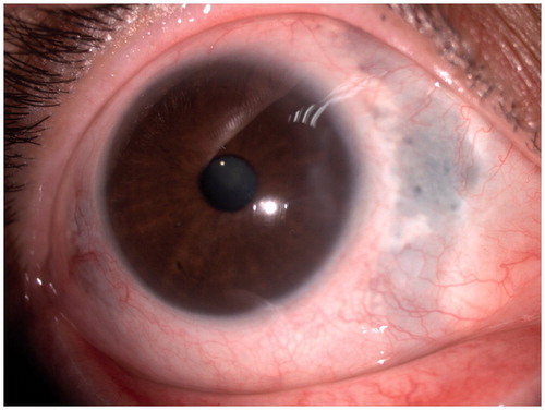 Figure 3. Anterior scleritis resolved.