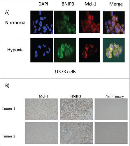 Figure 9. Mcl-1 and BNIP3 colocalize in glioma cells, GBM tumors and EGFRvIII expressing tumors. (A) U373 cells were placed under hypoxia for 16 hours. Cells were immunostained for Mcl-1, and BNIP3 and DNA was stained with DAPI. Cells were visualized using a confocal microscope. (B) GBM tumors were histochemical stain for BNIP3 and Mcl-1. Staining without primary antibodies was used as negative control. Tumor 1 represents a GBM tumor with high expression for both Mcl-1 and BNIP3. Tumor 2 represents a GBM tumor with low expression for both Mcl-1 and BNIP3. * represents statistically significant differences (p < 0.05).